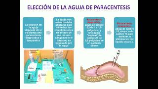 Paracentesis Abdominal [upl. by Nahtanaoj]