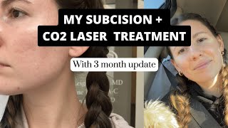 Getting a subcision  ablative CO2 Laser treatment  3 month update [upl. by Hsirahc289]