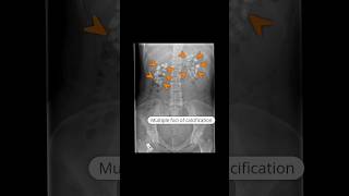 Medullary nephrocalcinosis due to type 1 renal tubular acidosis virlshorts [upl. by Adnohsad413]