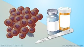 Treating Melanoma [upl. by Risay]