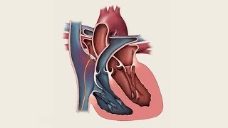 Mayo Clinic Minute What you need to know about patent foramen ovale [upl. by Taggart]