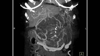 Abdomen Pancreas Pancreatic Mass 3D images demonstrate a large cystic pancreatic mass6 of 10 [upl. by Theodor]