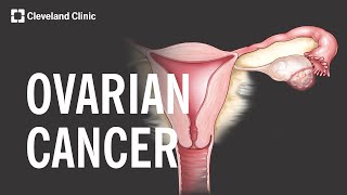 5 Warning Signs and Risk Factors of Ovarian Cancer [upl. by Jessie]