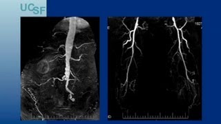 Endovascular Approaches for TASC CD Aortoiliac Lesions  UCSF Vascular Surgery Symposium 2013 [upl. by Islek]