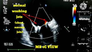 How to differentiate between normal washing jets and paravalvular leak [upl. by Schulein]