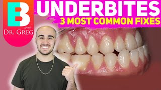 BRACES EXPLAINED Underbite  Crossbite Correction [upl. by Aztiray974]