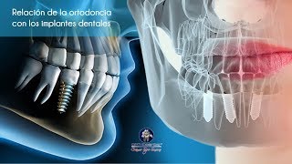 Relación de la ortodoncia con los implantes dentales Viva la Mañana [upl. by Raybourne]