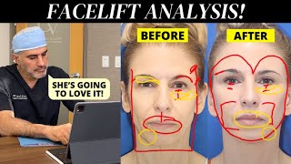 Facial Plastic Surgeon Analyzes his 63 year old patients face [upl. by Joline]