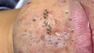 Big Cystic Acne Blackheads Extraction Blackheads amp Milia Whiteheads Removal Pimple Popping  2471 [upl. by Vaclava532]