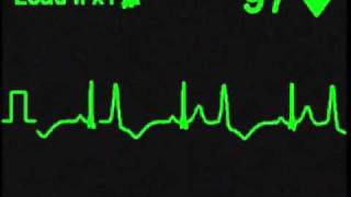 Ventricular Bigeminy  ECG Simulator  Arrhythmia Simulator [upl. by Delwin]