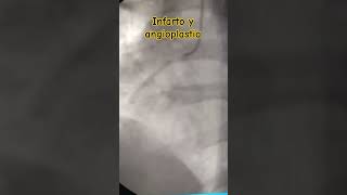 Angioplastia coronaria en el Infarto [upl. by Leffert]