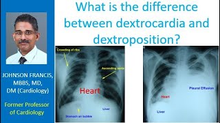 What is the difference between dextrocardia and dextroposition [upl. by Bledsoe]