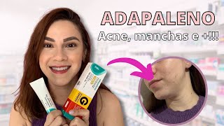 ADAPALENO ACABA COM A ACNE CLAREIA MANCHAS E MUITO MAIS [upl. by Hjerpe]