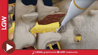 L5S1 Lumbar Discectomy and Fusion Surgery 3D animation [upl. by Cowley]