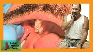 PAINFUL DENTAL ABSCESS DRAINED  Auburn Medical Group [upl. by Yttiy467]