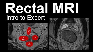 Rectal MRI Intro to Expert Rectal Cancer Staging [upl. by Ilac944]