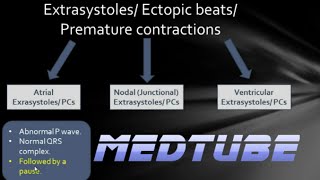 ECGs abnormal rhythms Extrasystoles [upl. by Yona]