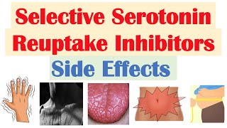 SSRI Antidepressant Side Effects amp Why They Occur  Fluoxetine Paroxetine Sertraline Citalopram [upl. by Gladwin]