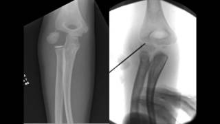 Percutaneous Screw Fixation of Lateral Condylar Humeral Fractures [upl. by Genevieve]