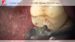 Caries Removal amp Cavity Preperation with Fotona Lightwalker ErYAG Laser [upl. by Maharba]