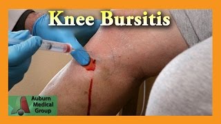 Pes Anserine Bursitis Knee Injection  Auburn Medical Group [upl. by Bradan]