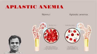 Aplastic Anemia [upl. by Francene]