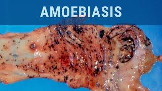 Amoebiasis  Pathology mini tutorial [upl. by Aiuqes292]