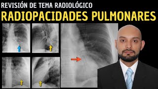 Revisión de Tema 88 Radiopacidades pulmonares [upl. by Ansela79]