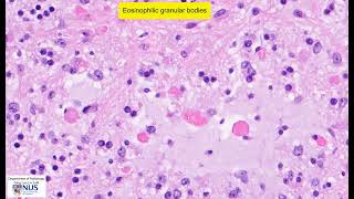 Pilocytic astrocytoma microscopy  Talking slide [upl. by Delmore]