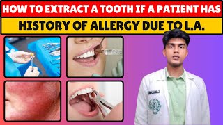 How to Extract a Tooth if Patient has known history of Allergic Reactions due to Local Anesthesia [upl. by Rafaello561]