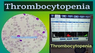 Thrombocytopenia  Low Platelets Count  ELearn with Technologist [upl. by Yenhoj]