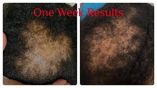 Batana Oil Hair Growth Review Testimonials  Before and After [upl. by Arytahs]