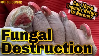 Fungal Destruction Can These Toenails Return To Normal [upl. by Adnorhs]