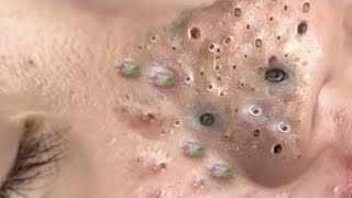 Big Cystic Acne Blackheads Extraction Blackheads amp Milia Whiteheads Removal Pimple Popping  2345 [upl. by Arehs]