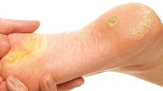 How to Get Rid of Calluses on Feet Overnight [upl. by Anaytat]