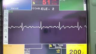 Fibrilacion Auricular en monitor 😯😯 [upl. by Nhepets]