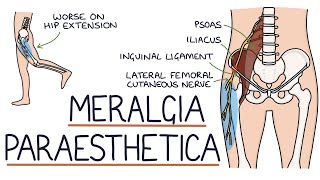 Understanding Meralgia Paraesthetica [upl. by Etnoved]