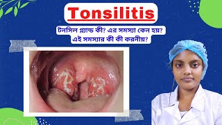 Tonsillitis In Bengali  Causes  Symptoms  Home Remedies  Treatments [upl. by Elcarim]