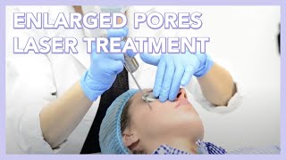 Enlarged Pores Laser Treatment [upl. by Pestana]