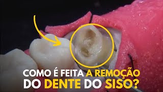 COMO É FEITA A REMOÇÃO DO DENTE DO SISO Dr Ronaldo Leite [upl. by Obadiah851]