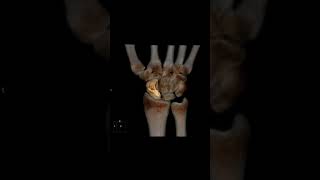 scaphoid bone fracture shortsfeed 3d [upl. by Nananne221]