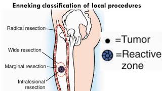 Bone Tumours for the FRCS orth [upl. by Sinnod]