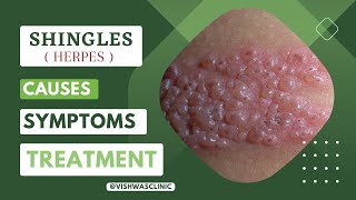 SHINGLES Herpes zoster Diseases  Causes Symptoms and Treatment [upl. by Aicilec477]