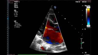 Anterior Mitral Valve Prolapse [upl. by Marilyn811]