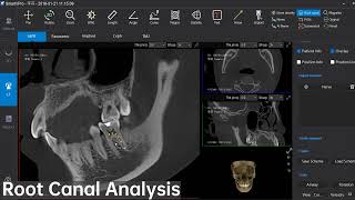 Root Canal Analysis Dental Cone Beam CT software Single function display  LargeV SmartVPro [upl. by Oilime536]