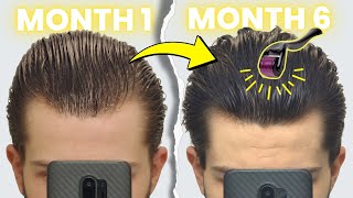 My 6 month Hair Regrowth Update Finasteride Minoxidil amp Dermaroller [upl. by Ayetal]