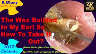 The Wax Built In My Ear😥So How To Take It Out🥰New Video Ear Wax Removal 1072 earwax earhealth [upl. by Hadwin]