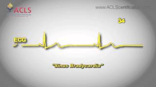 Sinus Bradycardia by ACLS Certification Institute [upl. by Eelac]