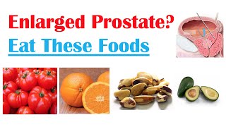 Enlarged Prostate Foods to Avoid [upl. by Norven295]