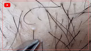 브라질리언 왁싱 족집게로 털 뽑아보기 Brazilian Waxing using tweezers [upl. by Clayborn822]